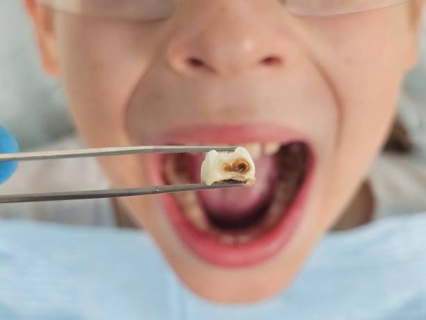 Best Emergency Dental Care for Abscessed Tooth in Whitesboro, NJ